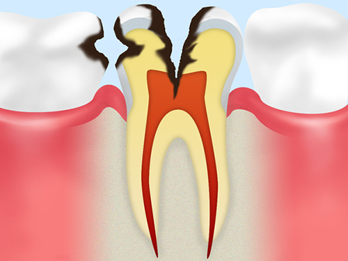 C3：虫歯の後期