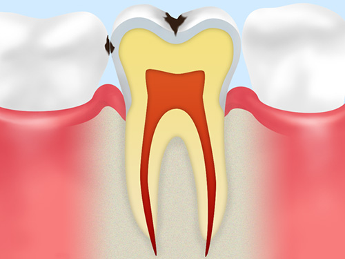 C1：虫歯の初期