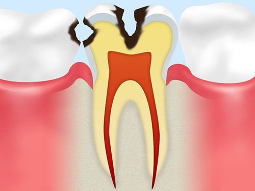 C2：虫歯の中期