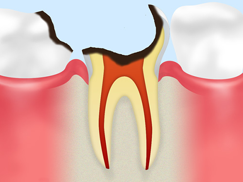 C4：虫歯の末期