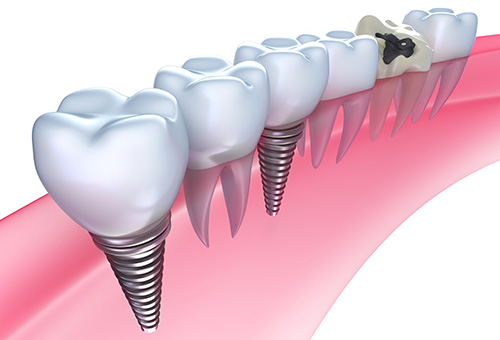 失った歯は保険適用から自費診療まで最適な治療が選べます