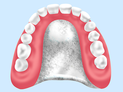 金属床義歯（チタン合金）