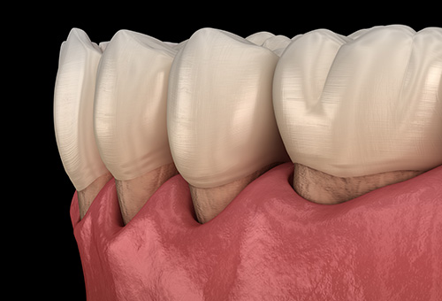 口腔ケアで治らない歯周病を効率よく改善する歯周内科