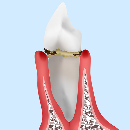 P1：第1段階「歯肉炎」