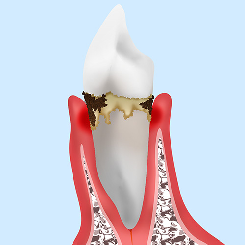 P2：第2段階「軽度歯周炎」