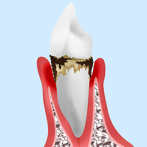 P3：第3段階「中度歯周炎」