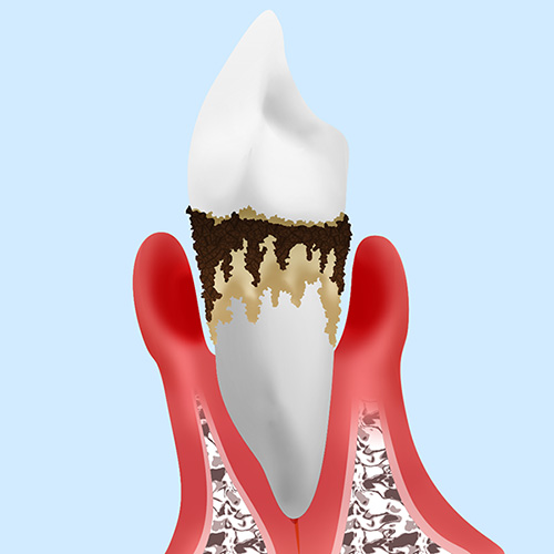 P4：第4段階「重度歯周炎」